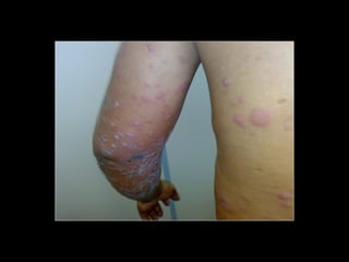 Simpósio Hanseníase - Hanseníase - dermatologista Carla