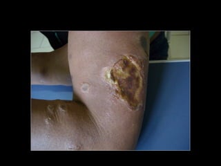 Simpósio Hanseníase - Hanseníase - dermatologista Carla