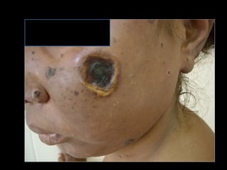 Simpósio Hanseníase - Hanseníase - dermatologista Carla