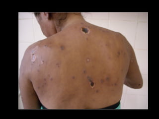 Simpósio Hanseníase - Hanseníase - dermatologista Carla