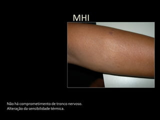 MHI
Não há comprometimento de tronco nervoso.
Alteração da sensibilidade térmica.
 