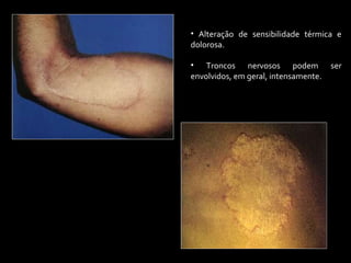 • Alteração de sensibilidade térmica e
dolorosa.
• Troncos nervosos podem ser
envolvidos, em geral, intensamente.
 