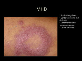 MHD
• Bordos irregulares.
• Contorno interno mal
definido.
• Geralmente vários
troncos nervosos.
• Lesões satélites.
 