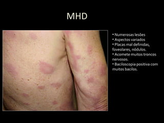 MHD
• Numerosas lesões
• Aspectos variados
• Placas mal definidas,
foveolares, nódulos.
• Acomete muitos troncos
nervosos.
• Baciloscopia positiva com
muitos bacilos.
 