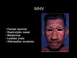 MHV
• Facies leonina
• Destruição nasal
• Madarose
• Lesões orais
• Alterações oculares
 
