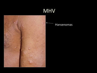 MHV
Hansenomas
 