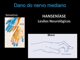 Dano do nervo mediano
Sensitivo
 