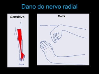 Dano do nervo radial
 
