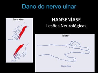 Dano do nervo ulnar
 