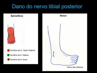 Dano do nervo tibial posterior
 