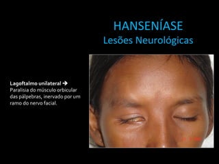 HANSENÍASE
Lesões Neurológicas
.
Lagoftalmo unilateral 
Paralisia do músculo orbicular
das pálpebras, inervado por um
ramo do nervo facial.
 