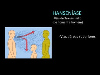 HANSENÍASE
Vias de Transmissão
(de homem a homem)
-Vias aéreas superiores
 