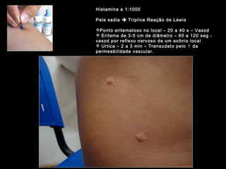 Histamina a 1:1000
Pele sadia  Triplice Reação de Lewis
Ponto eritematoso no local – 20 a 40 s – Vasod
 Eritema de 3-5 cm de diâmetro – 60 a 120 seg -
vasod por reflexo nervoso de um axônio local
 Urtica – 2 a 3 min – Transudato pelo ↑ da
permeabilidade vascular.
 