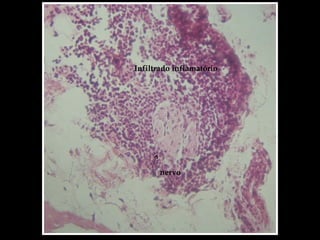 nervo
Infiltrado inflamatório
 