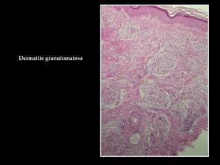 Dermatite granulomatosa
 