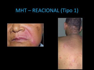 MHT – REACIONAL (Tipo 1)
 