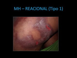MH – REACIONAL (Tipo 1)
 