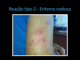 Reação tipo 2 - Eritema nodoso
 