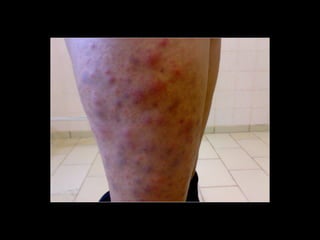 Simpósio Hanseníase - Hanseníase - dermatologista Carla