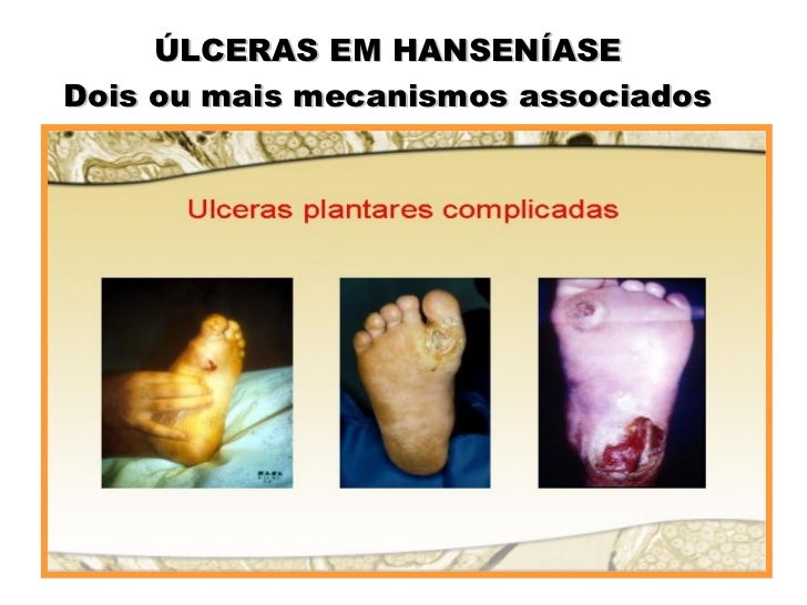 São Características Das Lesões Orais Na Hanseníase
