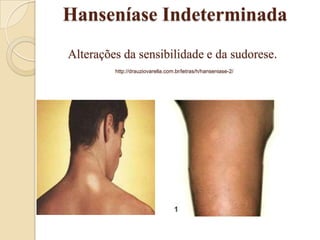 Hanseníase Indeterminada
Alterações da sensibilidade e da sudorese.
http://drauziovarella.com.br/letras/h/hanseniase-2/

 