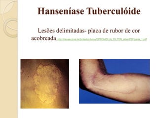 Hanseníase Tuberculóide
Lesões delimitadas- placa de rubor de cor
acobreada

http://hansen.bvs.ilsl.br/textoc/livros/OPROMOLLA_DILTOR_atlas/PDF/parte_1.pdf

 