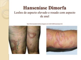 Hanseníase Dimorfa
Lesões de aspecto elevado e rosado com aspecto
de anel
http://informacoesbiomedicas.blogspot.com.br/2012/06/hanseniase.html

 
