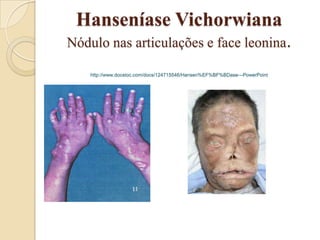 Hanseníase Vichorwiana
Nódulo nas articulações e face leonina.
http://www.docstoc.com/docs/124715546/Hansen%EF%BF%BDase---PowerPoint

 