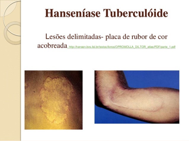 Hanseníase Do Conceito Ao Tratamento Slids Hanseníase Do Conceito Ao Tratamento Slids