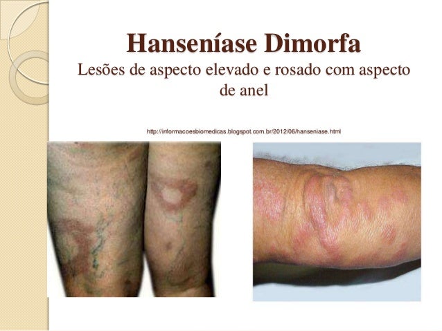 Hanseníase Do Conceito Ao Tratamento Slids Hanseníase Do Conceito Ao Tratamento Slids