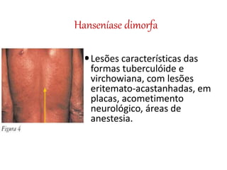 Hanseníase dimorfa
Lesões características das
formas tuberculóide e
virchowiana, com lesões
eritemato-acastanhadas, em
placas, acometimento
neurológico, áreas de
anestesia.
 