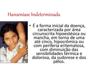 Hanseníase Indeterminada
• É a forma inicial da doença,
caracterizada por área
circunscrita hipoestésica ou
mancha, em torno de uma
até cinco, hipocrômica ou
com periferia eritematosa,
com diminuição das
sensibilidades térmica e
dolorosa, da sudorese e dos
pêlos.
 