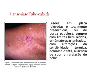 Hanseníase Tuberculoide
• Lesões em placa
(elevadas e totalmente
preenchidas) ou de
borda papulosa, sempre
com limites bem nítidos,
eritêmato-acastanhadas,
com alterações da
sensibilidade térmica,
dolorosa e tátil, ausência
de suor e rarefação de
pêlos.
 