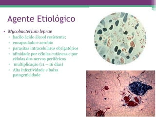 Agente Etiológico
• Mycobacterium leprae
  ▫ bacilo ácido álcool resistente;
  ▫ encapsulado e aerobio
  ▫ parasitas intracelulares obrigatórios
  ▫ afinidade por células cutâneas e por
    células dos nervos periféricos
  ▫ multiplicação (11 – 16 dias)
  ▫ Alta infectividade e baixa
    patogenicidade
 