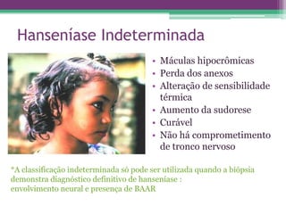 Hanseníase Indeterminada
                                       • Máculas hipocrômicas
                                       • Perda dos anexos
                                       • Alteração de sensibilidade
                                         térmica
                                       • Aumento da sudorese
                                       • Curável
                                       • Não há comprometimento
                                         de tronco nervoso

*A classificação indeterminada só pode ser utilizada quando a biópsia
demonstra diagnóstico definitivo de hanseníase :
envolvimento neural e presença de BAAR
 