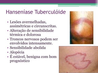 Hanseníase Tuberculóide
• Lesões avermelhadas,
  assimétricas e circunscritas.
• Alteração de sensibilidade
  térmica e dolorosa
• Troncos nervosos podem ser
  envolvidos intensamente.
• Sensibilidade abolida
• Alopécia
• É estável, benigna com bom
  prognóstico
 