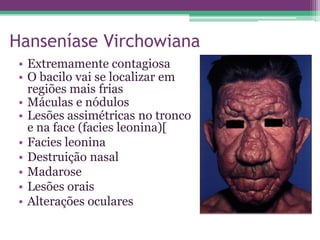Hanseníase Virchowiana
 • Extremamente contagiosa
 • O bacilo vai se localizar em
   regiões mais frias
 • Máculas e nódulos
 • Lesões assimétricas no tronco
   e na face (facies leonina)[
 • Facies leonina
 • Destruição nasal
 • Madarose
 • Lesões orais
 • Alterações oculares
 