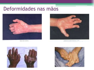 Deformidades nas mãos
 