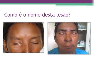 Como é o nome desta lesão?
 