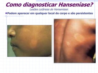 Como diagnosticar Hanseníase?
Lesões cutâneas de Hanseníase:
Podem aparecer em qualquer local do corpo e são persistentes
 