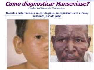 Como diagnosticar Hanseníase?
Lesões cutâneas de Hanseníase:
Nódulos eritematosos ou cor da pele, ou espessamento difuso,
brilhante, liso da pele.
 