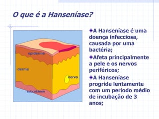 O que é a Hanseníase?
nervo
derme
epiderme
subcutâneo
A Hanseníase é uma
doença infecciosa,
causada por uma
bactéria;
Afeta principalmente
a pele e os nervos
periféricos;
A Hanseníase
progride lentamente
com um período médio
de incubação de 3
anos;
 