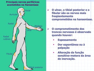 Tibial posterior
Fibular
Radial
cutâneo
Radial
Mediano
Ulnar
Facial
Auricular
Principais nervos periféricos
acometidos na Hanseníase
 O ulnar, o tibial posterior e o
fibular são os nervos mais
freqüentemente
comprometidos na hanseníase.
 O comprometimento dos
troncos nervosos é observado
quando houver:
 Espessamento
 Dor espontânea ou à
palpação
 Alteração da função
sensitivo-motora da área
de inervação.
 