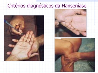 Critérios diagnósticos da Hanseníase
 