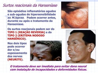 Surtos reacionais da Hanseníase
São episódios inflamatórios agudos
e sub-agudos de hipersensibilidade
ao M.leprae. Podem ocorrer antes,
durante ou após o tratamento da
Hanseníase.
Os surtos reacionais podem ser do
TIPO 1 (REAÇÃO REVERSA) e do
TIPO 2 (ERITEMA NODOSO
HANSÊNICO).
O tratamento deve ser imediato para evitar dano neural
com instalação de incapacidades e deformidades físicas.
Nos dois tipos
pode ocorrer
dor e/ou
espessamento
dos nervos
(NEURITE).
 