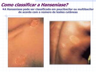 Como classificar a Hanseníase?
A Hanseníase pode ser classificada em paucibacilar ou multibacilar
de acordo com o número de lesões cutâneas
 