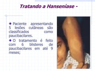 Tratando a Hanseníase -
Paciente apresentando
5 lesões cutâneas são
classificados como
paucibacilares.
O tratamento é feito
com 6 blisteres de
paucibacilares em até 9
meses;
 