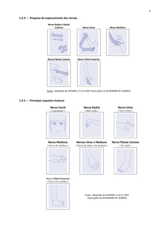 5.2.4 – Pesquisa de espessamento dos nervos
Nervo Radial e Radial
Cutâneo Nervo Ulnar Nervo Mediano
Nervo Fibular Comum Nervo Tibial Posterior
Fonte: Adaptado de LEHMAN, LF et al,1997 (Ilustrações de ALEXANDRE M. SOARES)
5.2.5 – Principais sequelas motoras
Nervo Facial
( Lagoftalmo )
Nervo Radial
( Mão caída )
Nervo Ulnar
( Garra ulnar )
Nervo Mediano
( Garra do mediano )
Nervos Ulnar e Mediano
( Garra do ulnar e do mediano )
Nervo Fibular Comum
( Pé caído )
Nervo Tibial Posterior
( Garra dos artelhos )
Fonte: Adaptado de LEHMAN, LF et al, 1997
(Ilustrações de ALEXANDRE M. SOARES)
8
 
