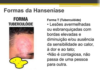 Formas da Hanseníase
              Forma T (Tuberculóide)
              • Lesões avermelhadas
              ou esbranquiçadas com
              bordas elevadas e
              diminuição e/ou ausência
              da sensibilidade ao calor,
              à dor e ao tato;
              •Não é contagiosa, não
              passa de uma pessoa
              para outra.
 