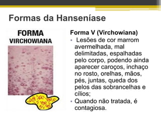 Formas da Hanseníase
            Forma V (Virchowiana)
            • Lesões de cor marrom
              avermelhada, mal
              delimitadas, espalhadas
              pelo corpo, podendo ainda
              aparecer caroços, inchaço
              no rosto, orelhas, mãos,
              pés, juntas, queda dos
              pelos das sobrancelhas e
              cílios;
            • Quando não tratada, é
              contagiosa.
 